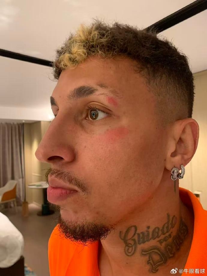 記者：克雷桑頭部被踢了一下，換下他是用了腦震蕩條款